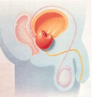 有效治疗前列腺增生方法是什么