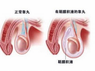 睾丸鞘膜积液的预防有哪些